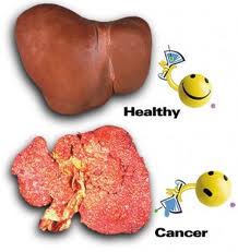 kancer jetre
