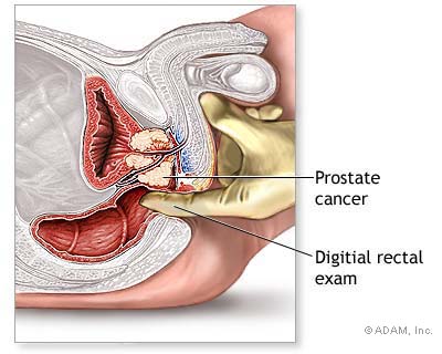 lecenje prostate iskustva