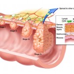 Karcinom debelog creva