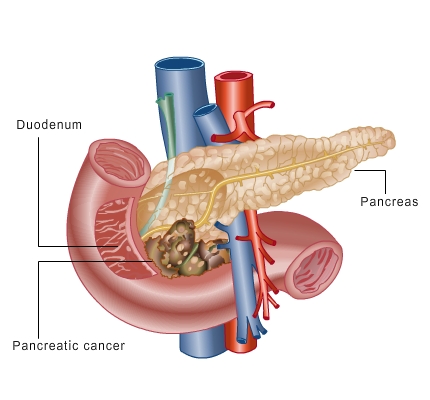 Tumor pankreasa