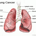 Kancer pluća