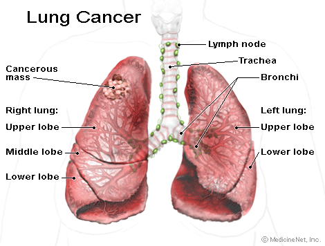 Kancer pluća