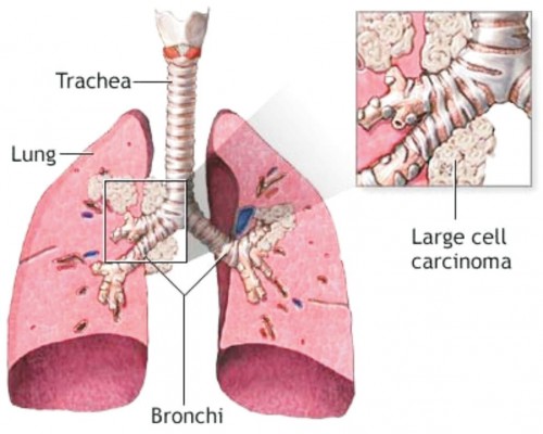 Kancer pluća