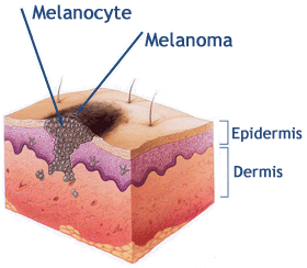 melanom