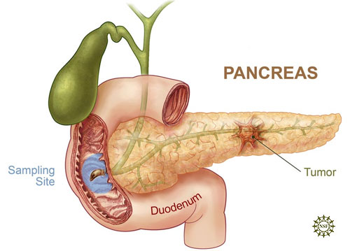 Pankreas tumor