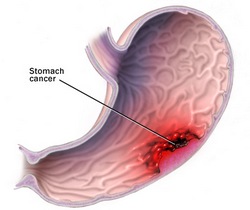 Rak želuca