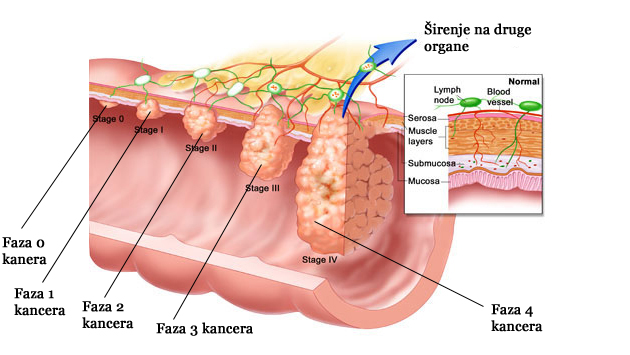 Faze kancera debelog creva