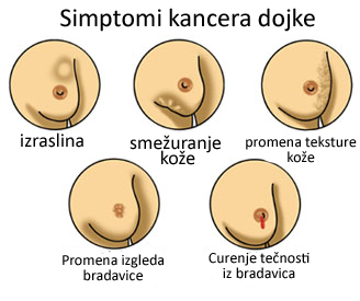 karcinom-dojke