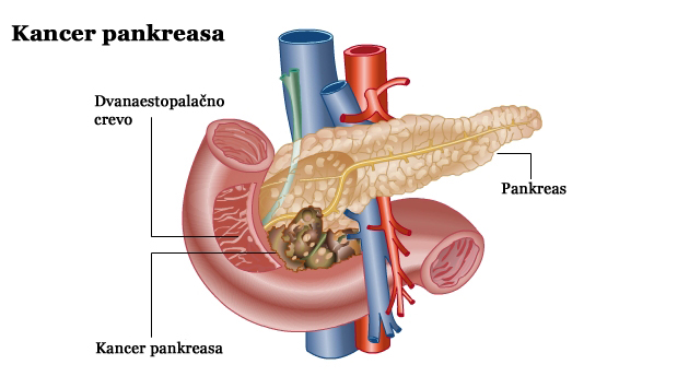 Kancer pankreasa