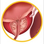 Rak prostate