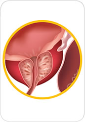 Rak prostate