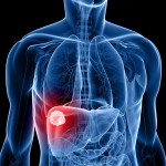 faktori rizika za tumor jetre