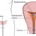 karcinom endometrijuma