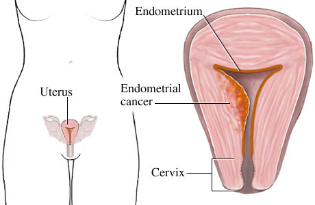 karcinom endometrijuma