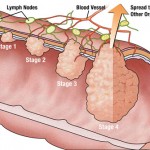 Karcinom kolona