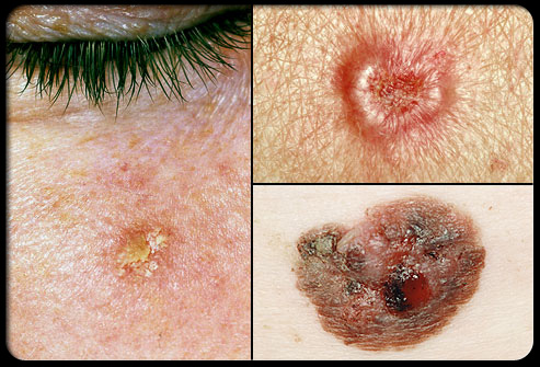 Znakovi i simptomi bazalnog i skvamoznog karcinoma kože