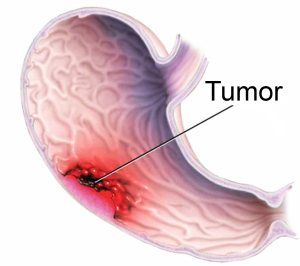 Tumor želuca