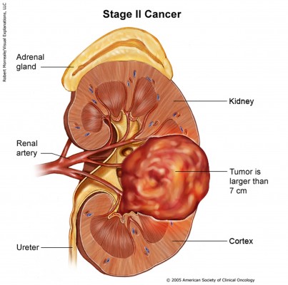 tumor bubrega