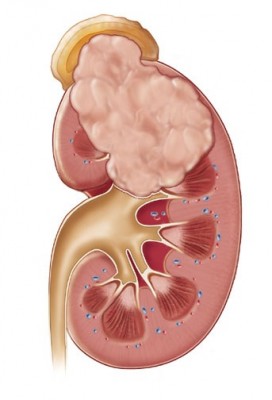 Vilmsov tumor