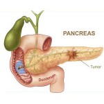 kancer pankreasa