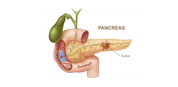 kancer pankreasa