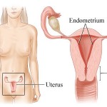 Karcinom endometrijuma
