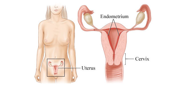 Karcinom endometrijuma