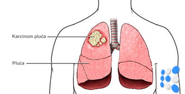 karcinom-pluca