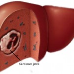 Karcinom-jetre