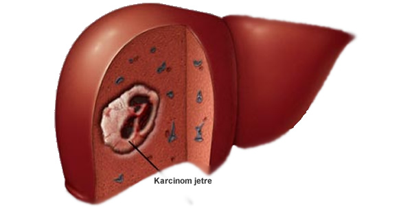 Karcinom-jetre